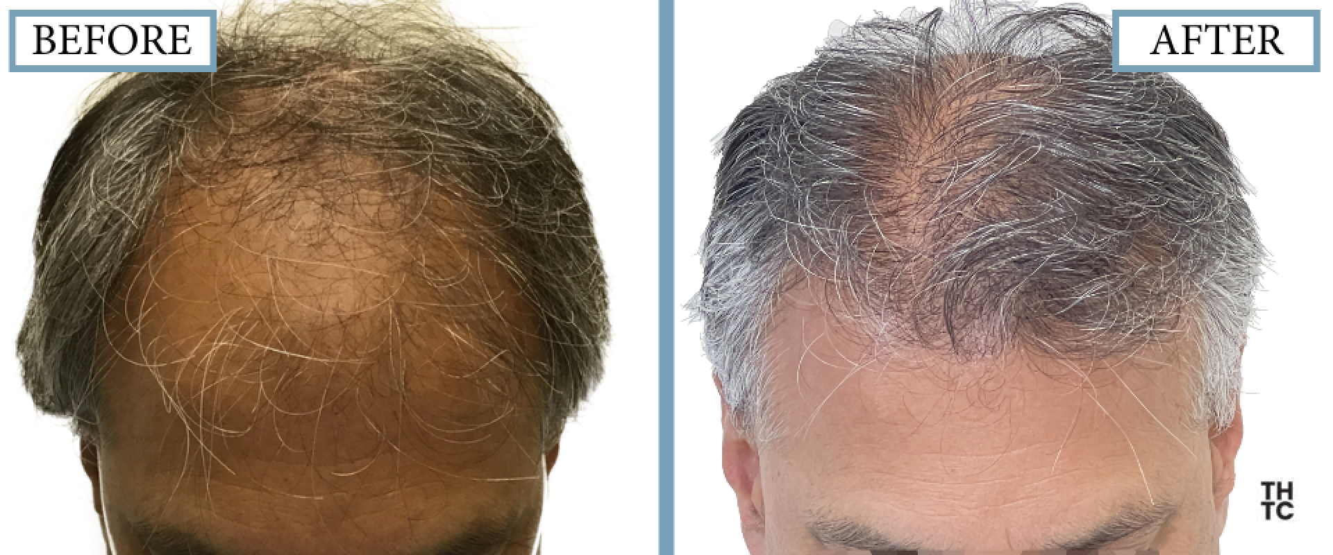 Hair Transplant Toronto
